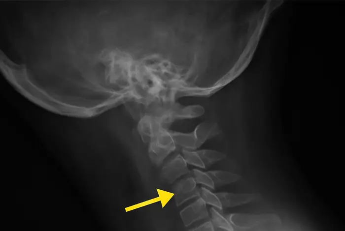 How DMX Reveals Hidden Cervical Instability Before Your PRP or Stem‑Cell Treatment - Lateral X-ray image of the cervical spine showing a yellow arrow pointing to a suspected area of instability in the neck vertebrae.