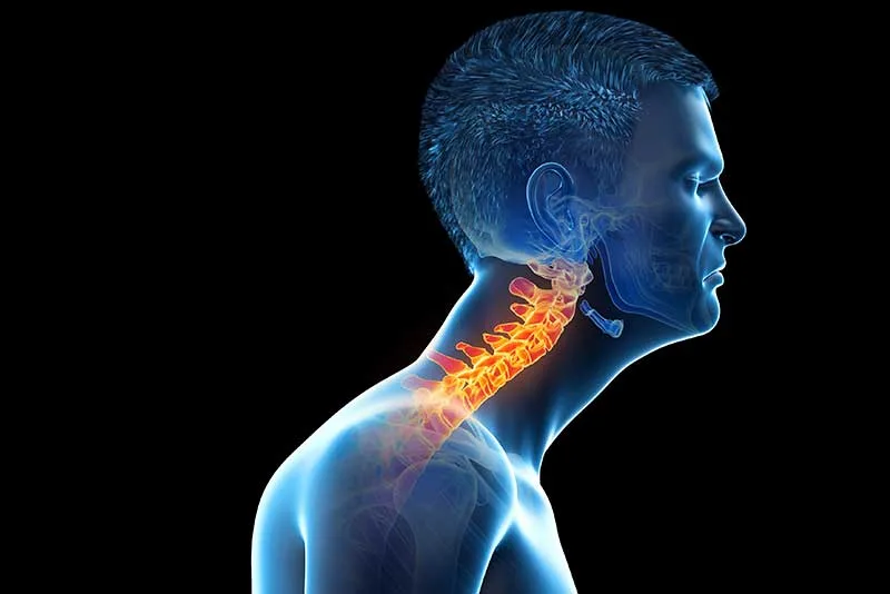 digital motion x‑ray-for-cervical instability after failed diagnostics 3D medical illustration of a man with cervical spine highlighted in orange, indicating neck pain or spinal instability.