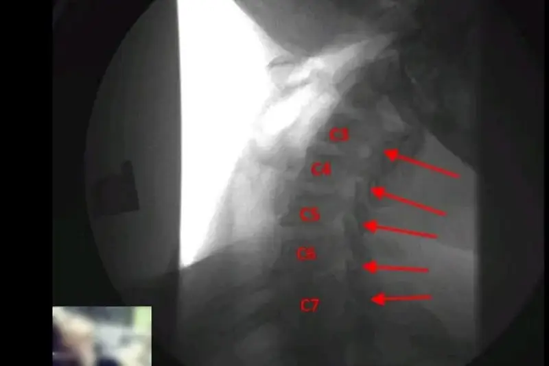 Digital Motion X-Ray (DMX) image of the cervical spine showing vertebrae C3 to C7 labeled with red arrows, highlighting potential areas of instability or ligament damage.