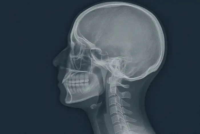 Lateral X-ray image of a human head and cervical spine with the title 'What Is Digital Motion X-Ray (DMX)?' in bold white text on a dark blue background.