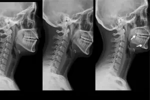 DMX for Migraines – radiografías dinámicas del cuello mostrando inestabilidad cervical en diferentes movimientos del segmento C0–C1–C2.