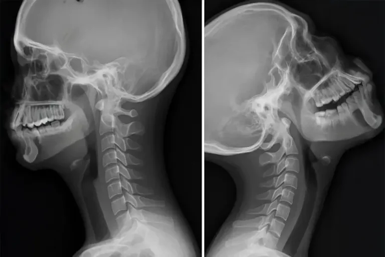 explain your chronic neck pain - Side-by-side cervical spine X-rays showing head and neck in different positions, illustrating movement and potential instability in the upper cervical spine.