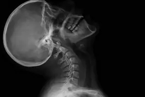 Lateral X-ray of a human head and neck in extension, showing cervical spine alignment and vertebrae.