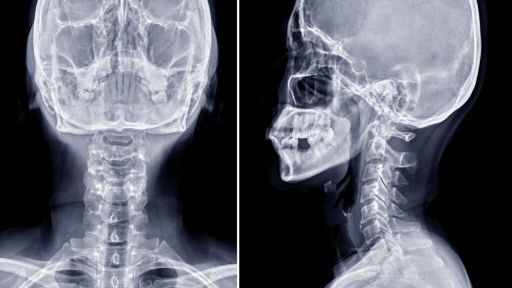 The Connection Between Digital Motion X-Ray Findings and Poor Postural Control