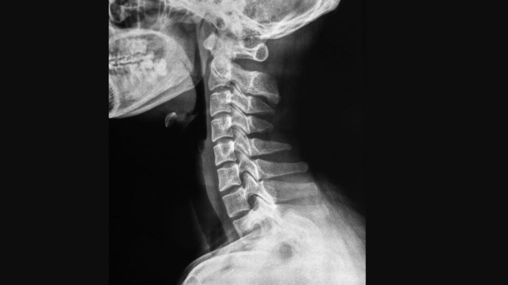 Chronic Headache Cases