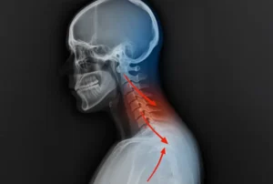 Digital Motion X-Ray in Miami showing neck ligament instability linked to headaches and migraines.
