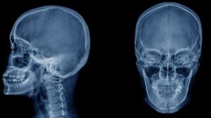 The Connection Between Digital Motion X-Ray Findings and Poor Postural Control