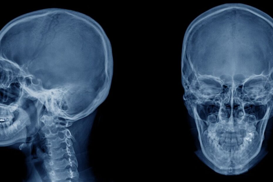 The Connection Between Digital Motion X-Ray Findings and Poor Postural Control
