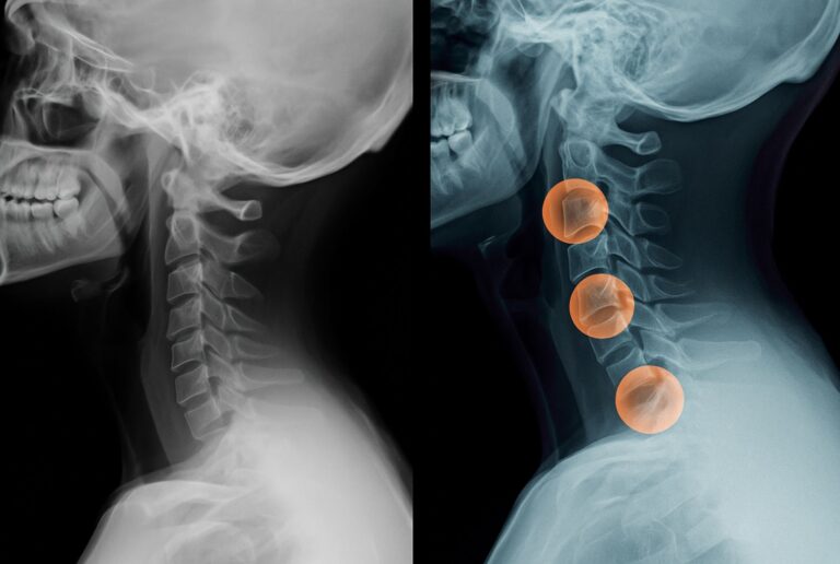 Patient experiencing vertigo and neck discomfort caused by cervical ligament instability, looking concerned while touching the back of the neck